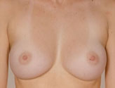 Patient # 13100 After Photo # 2